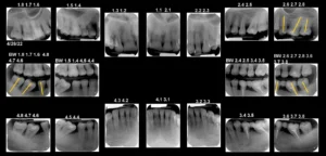 Ortodonția: un pas esențial înaintea lucrărilor dentare complexe