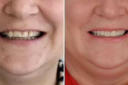 Ortodonția: un pas esențial înaintea lucrărilor dentare complexe