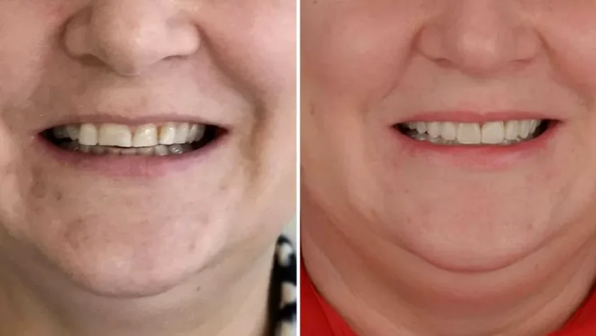 Ortodonția: un pas esențial înaintea lucrărilor dentare complexe