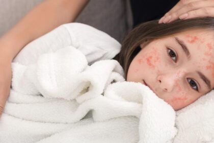 Rujeola (pojarul): Cauze, simptome, transmitere, complicații și tratament