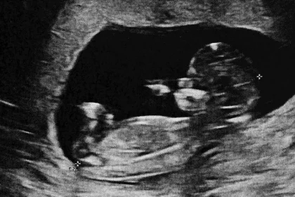 Fenomen medical incredibil: cum un făt mort poate rămâne în corp zeci de ani fără simptome