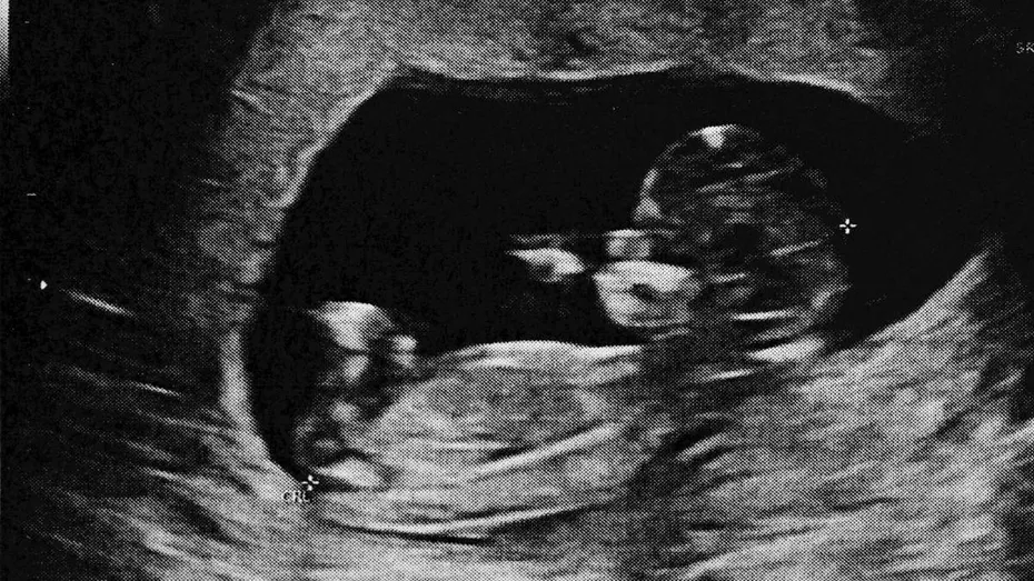 Fenomen medical incredibil: cum un făt mort poate rămâne în corp zeci de ani fără simptome