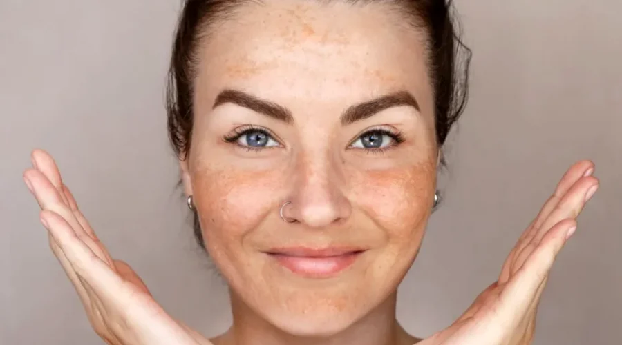 De ce apar petele pigmentare chiar dacă folosești zilnic SPF. Greșelile care pot reduce protecția pielii
