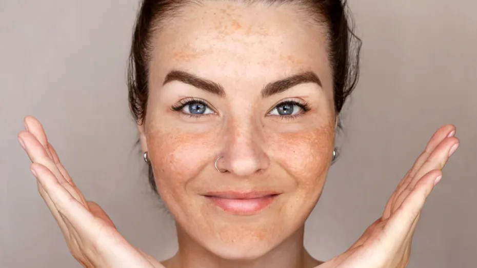 De ce apar petele pigmentare chiar dacă folosești zilnic SPF. Greșelile care pot reduce protecția pielii